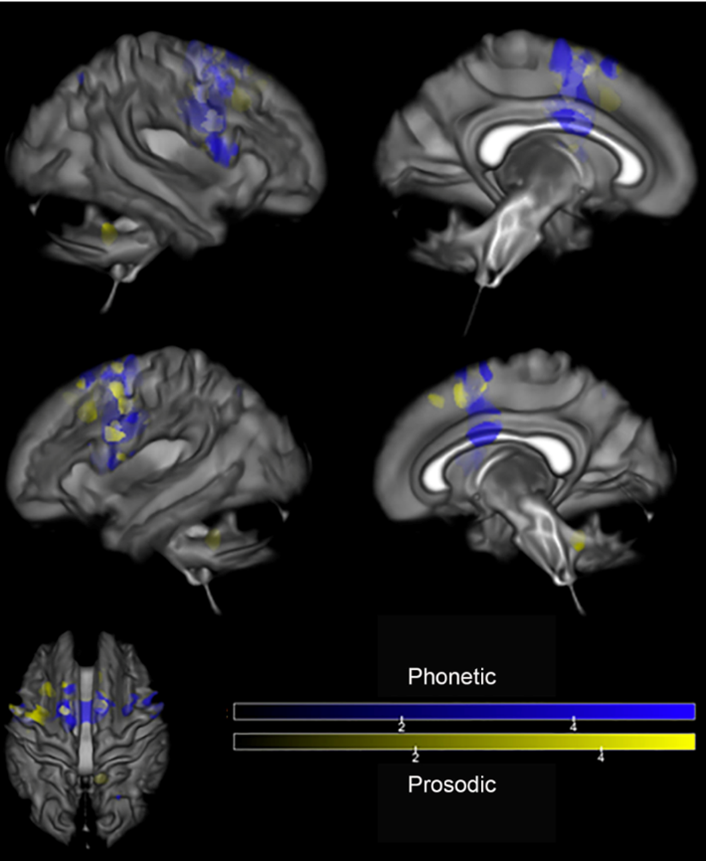 Imaging with DTI demonstrates areas of white matter tract atrophy for patients with Prosodic and Phonetic subtypes of PPAOS
